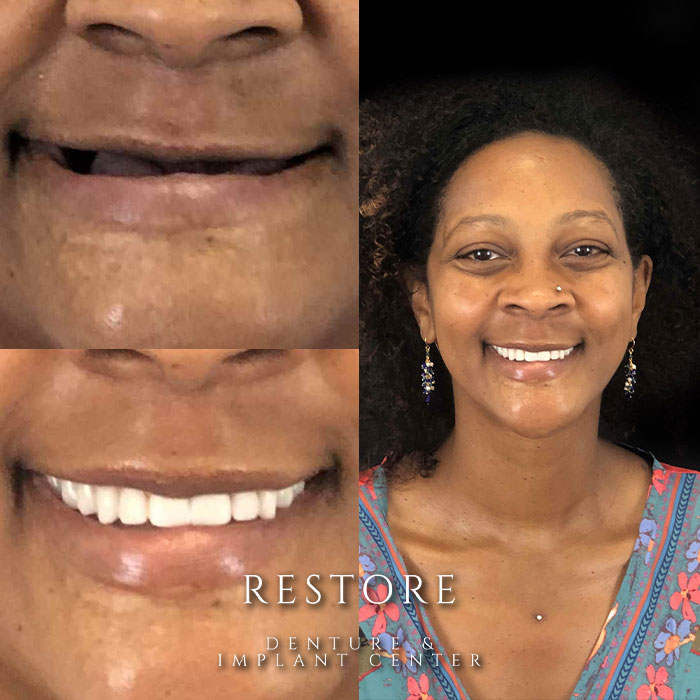 Restore Denture & Implant Center before & after photo