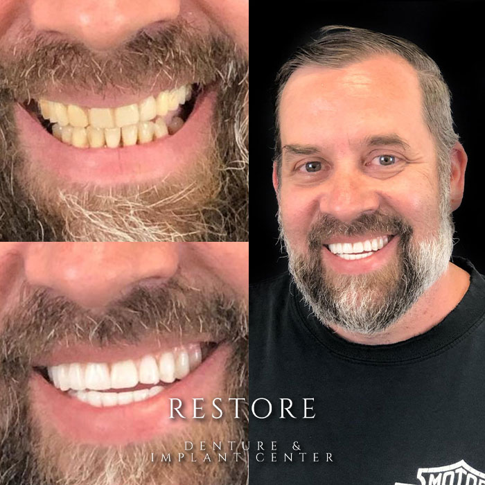 Restore Denture & Implant Center before & after photo
