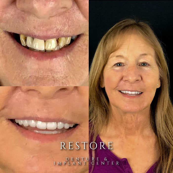 Restore Denture & Implant Center before & after photo