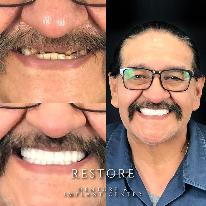 Restore Denture & Implant Center before & after photo